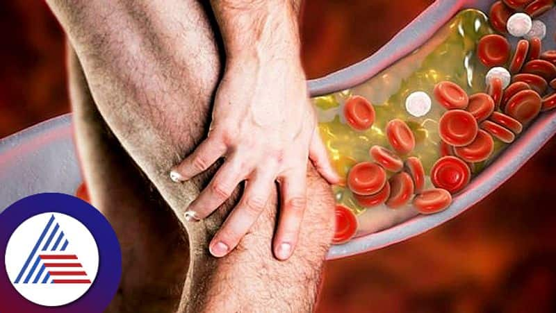 High Cholesterol may cause these effects on legs that leads to heart health problem pav 