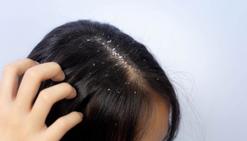 use camphor to get rid of dandruff azn 