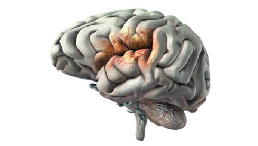  brain stroke