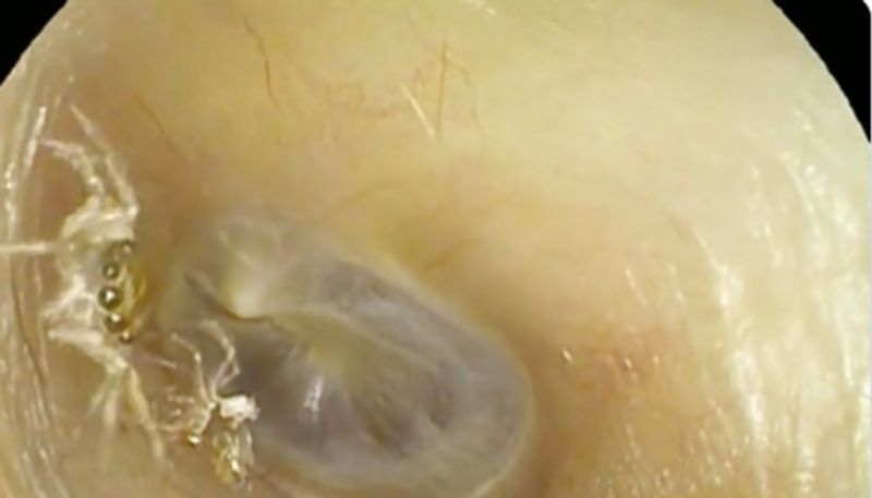 doctors found living spider inside the ear of a woman hyp