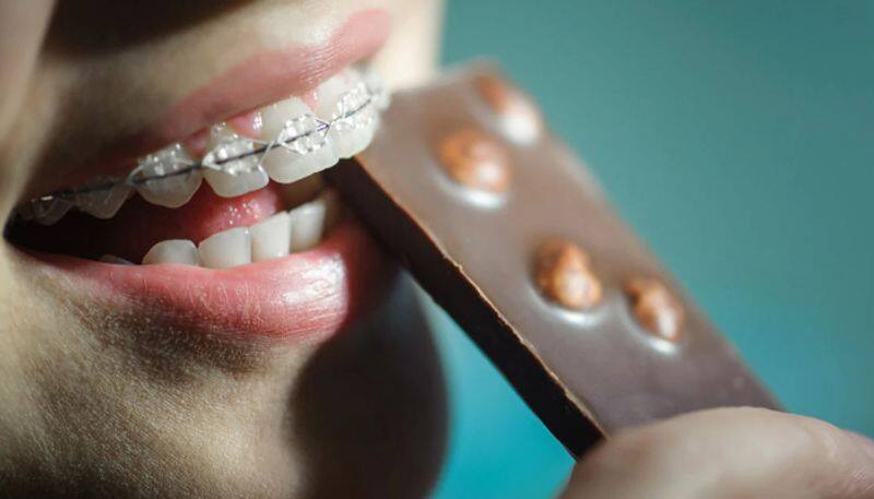 Foods you should avoid While wearing Braces