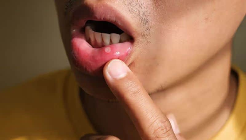 home remedies to heal mouth ulcers or canker sores rsl