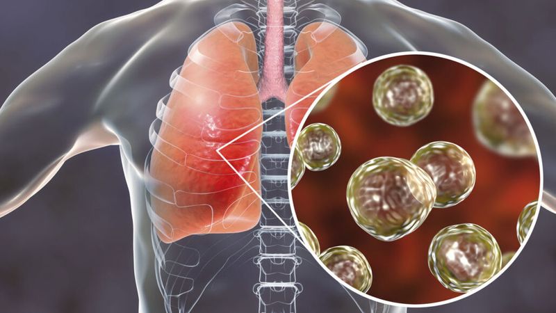 what is fungal pneumonia and symptoms 