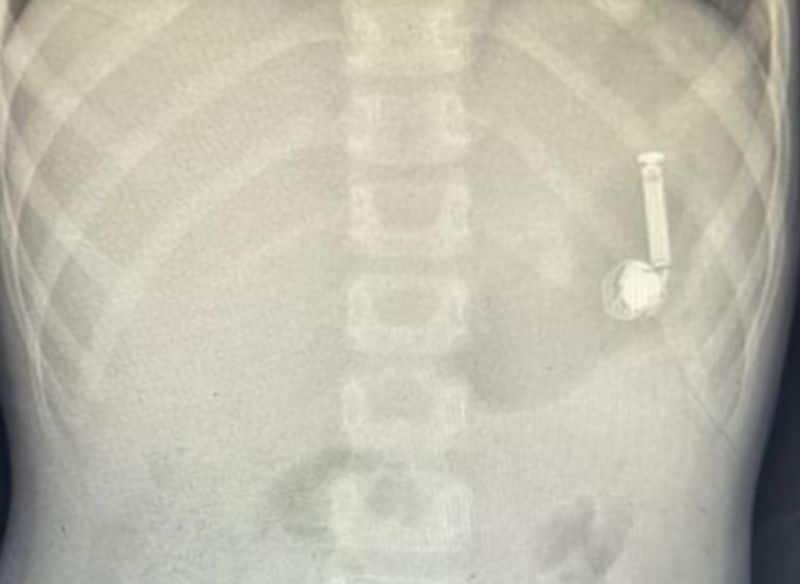 ten year old boy swallowed ear bud in makkah 