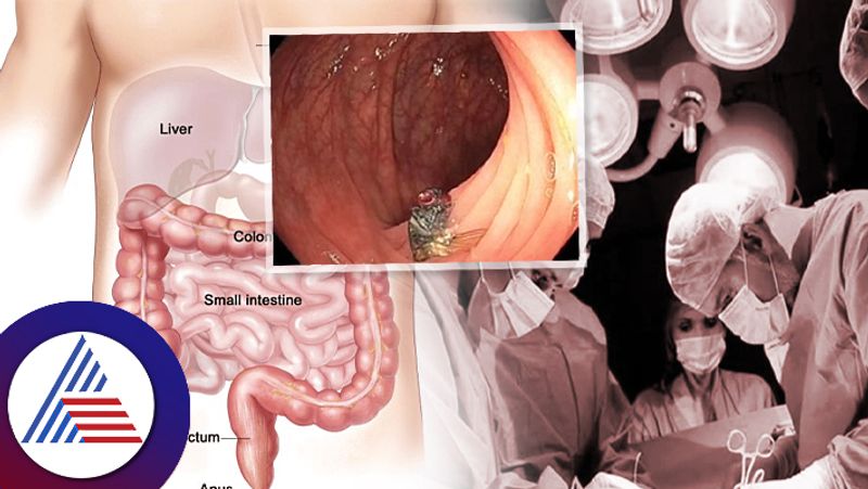 Doctors Find Living Fly In Man Intestines During Colonoscopy roo