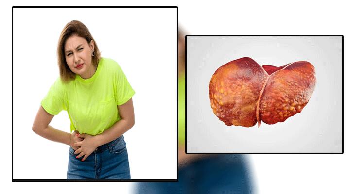 fatty liver