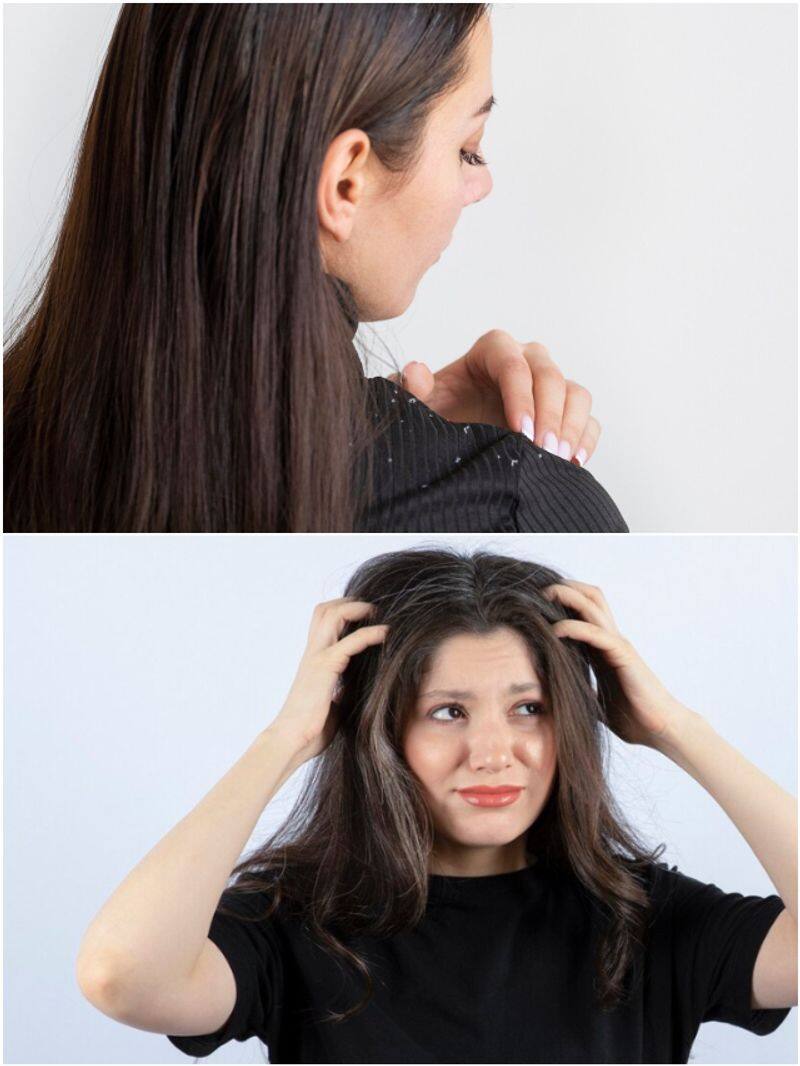 Winter hair care: 7 practices to avoid for dandruff-free locks SHG