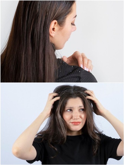 Winter hair care: 7 practices to avoid for dandruff-free locks