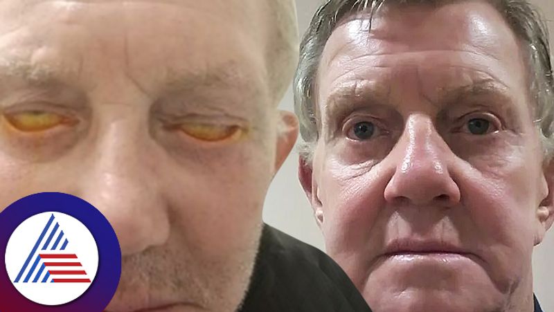 Old Man Can Not Close Eyes Four Years Botched Cosmetic Surgery To Fix Cheeks roo