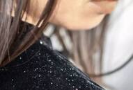 home remedies for dandruff zkamn