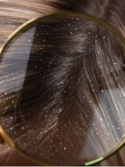 <p>(Dandruff) एक आम समस्या बन चुकी है लेकिन इसकी वजह से अक्सर  शर्मिंदा होना पड़ता है, ये अक्सर कपड़ो पर गिरी नज़र आती है। </p>
