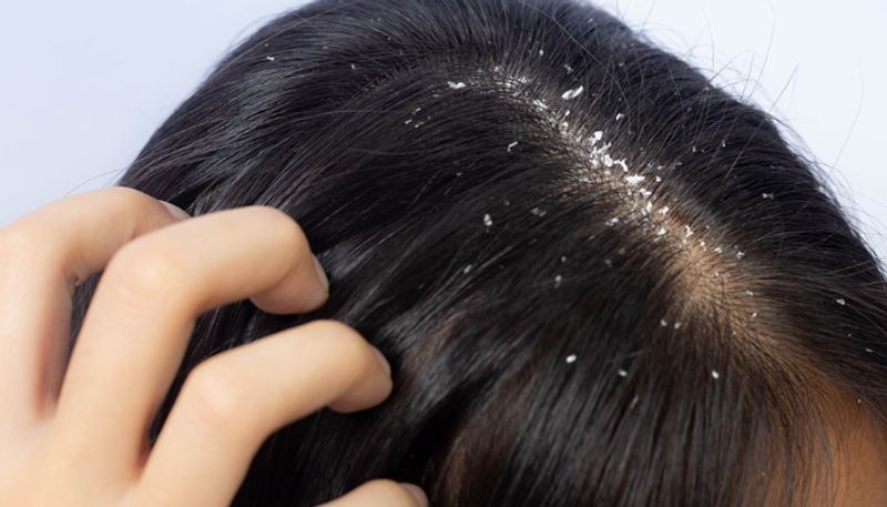 how to get rid of dandruff at home