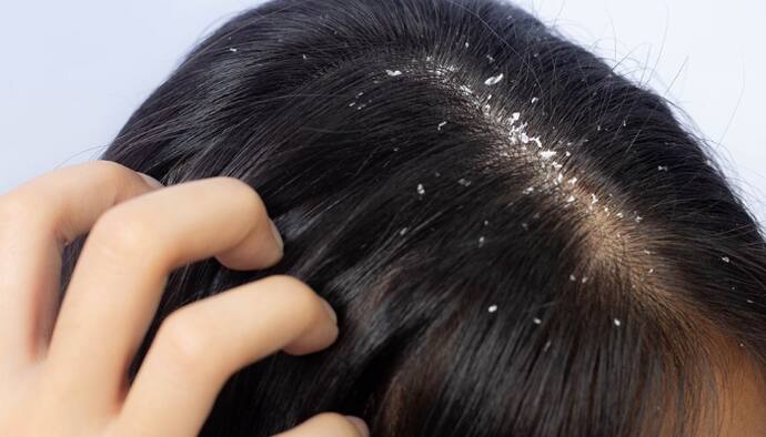 dandruff