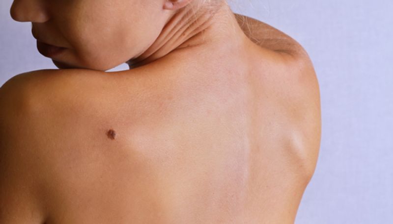 signs and symptoms of Melanoma skin cancer 