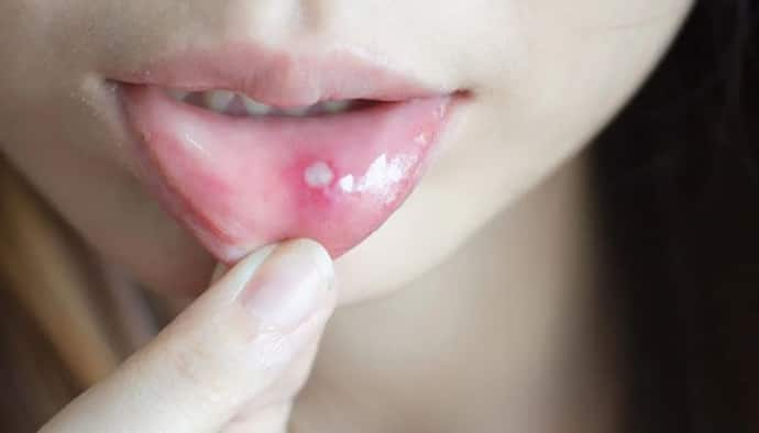 mouth ulcers