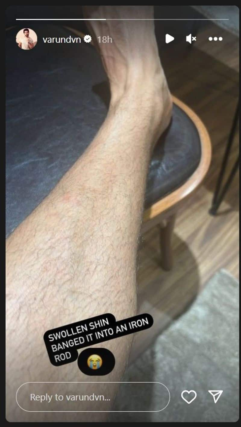 Varun Dhawan gets injured while shooting for upcoming film, shares update on swollen leg RKK