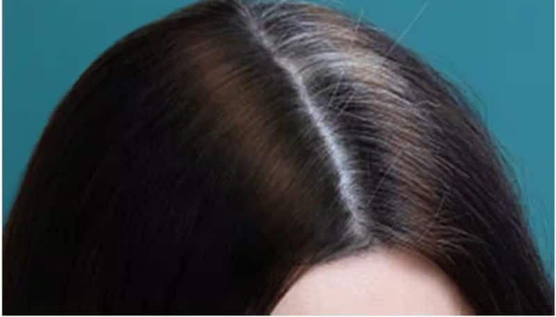 reasons and remedies for premature greying of hair