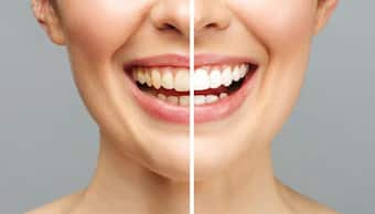 Effective home remedies for removing yellow stains from teeth