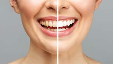 Effective home remedies for removing yellow stains from teeth | Asianet  Newsable