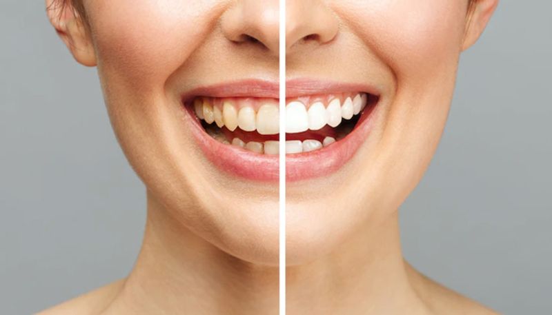 Effective home remedies for removing yellow stains from teeth | Asianet Newsable