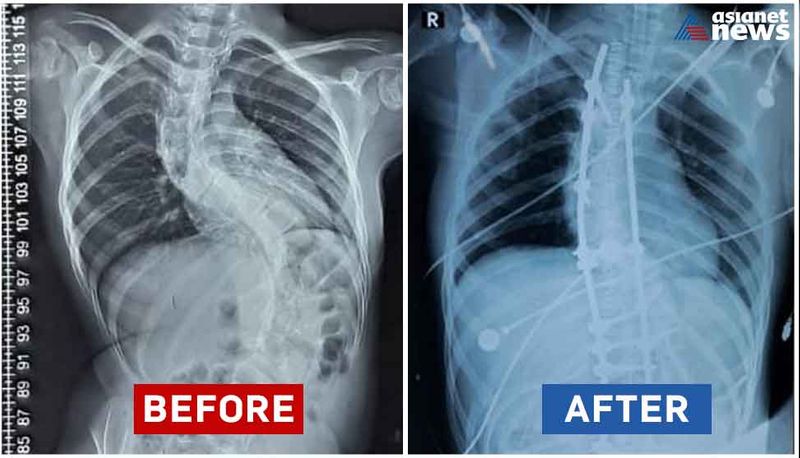 Baby Fatima with epiphyseal Dysplasia when nava kerala sadas ends she can walk steady btb