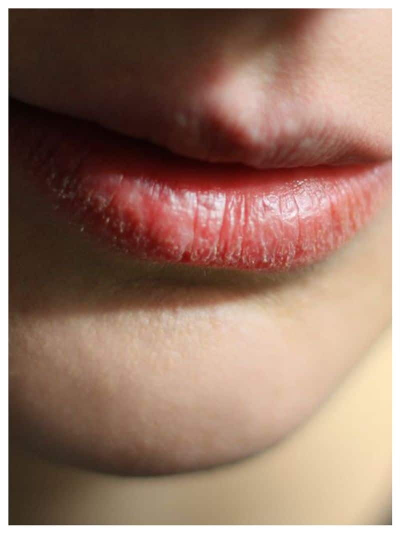 home remedies for dry lips in winter rsl