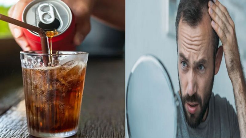 Male pattern baldness that wont go away, Blame your soda, sugar intake Vin