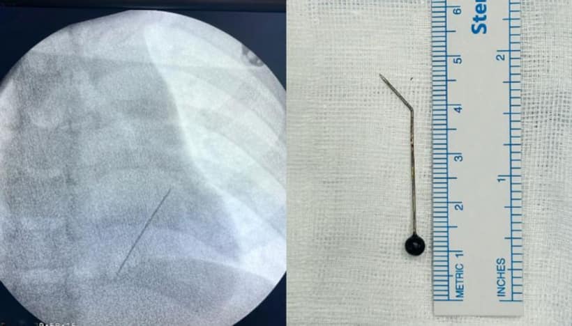 Kerala: 7 year old boy from Maldives accidentally swallows 5 cm long needle; undergoes surgery in Kochi