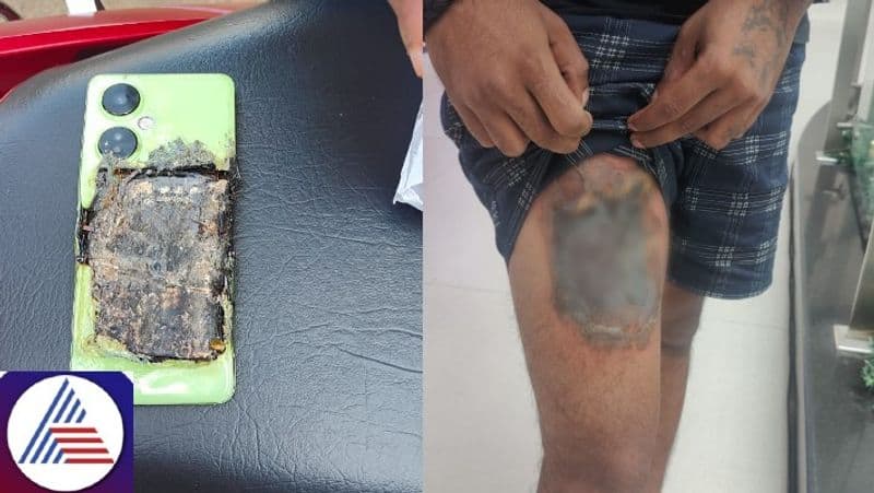 Bengaluru: New Oneplus device explodes in pocket, customer seeks full medical coverage from company vkp