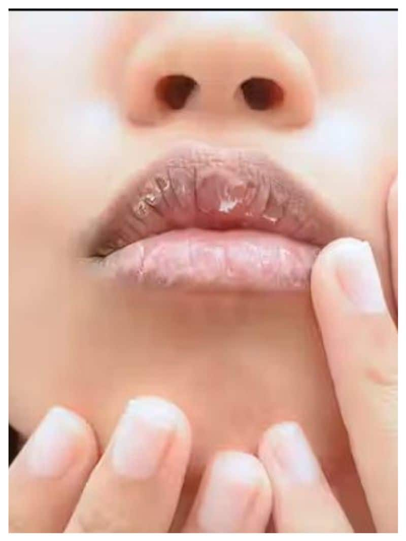 Effective home remedies for chapped lips: Tips to smoothen lips vkp