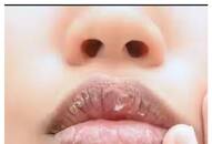 Say goodbye to chapped lips: Effective home remedies that work RTM