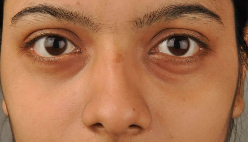 causes of dark circles and how to reduce them naturally