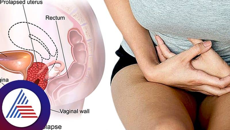 What is prolapsed uterus or uterus coming out which causes due to constipation and painful intercourse pav