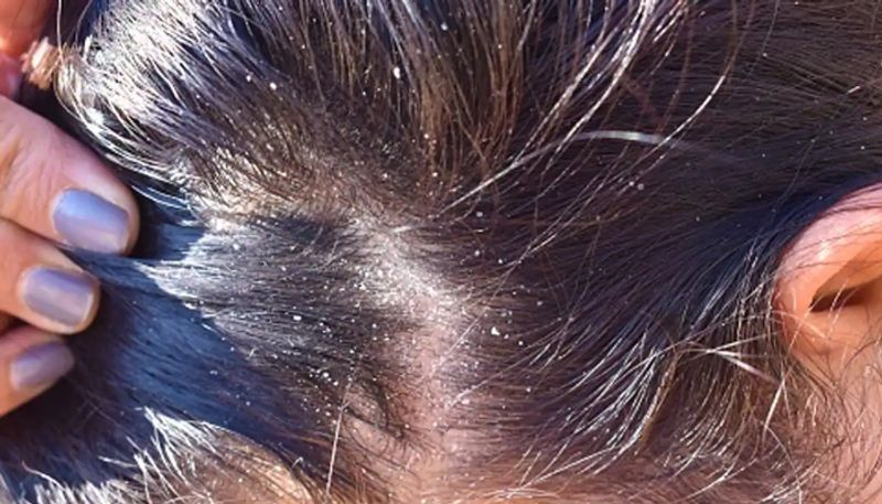 7 Effective Remedies to get rid of Dandruff 