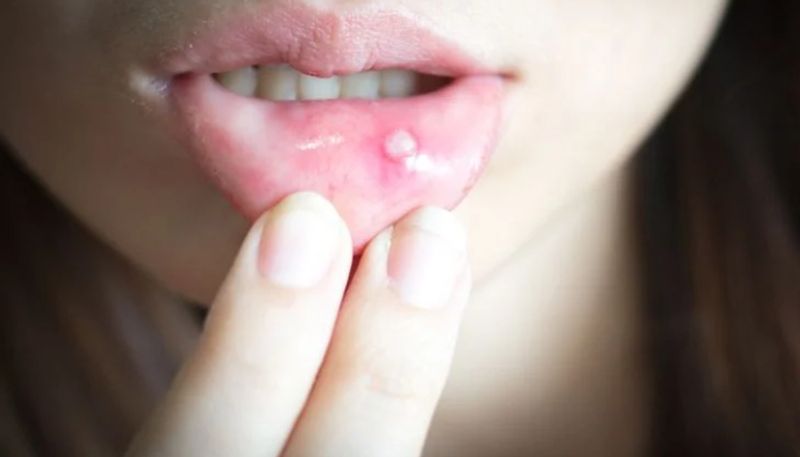 foods that can trigger mouth ulcers