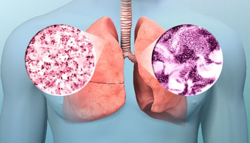 Lung Cancer: Know the Signs, causes, symptoms, and early detection RBA