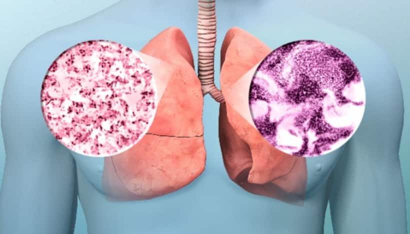 Lung cancer: धीरे धीरे लाखों जिंदगी निगल रहा लंग कैंसर, कहीं आप भी तो नहीं कर रहे ये गलतियां 