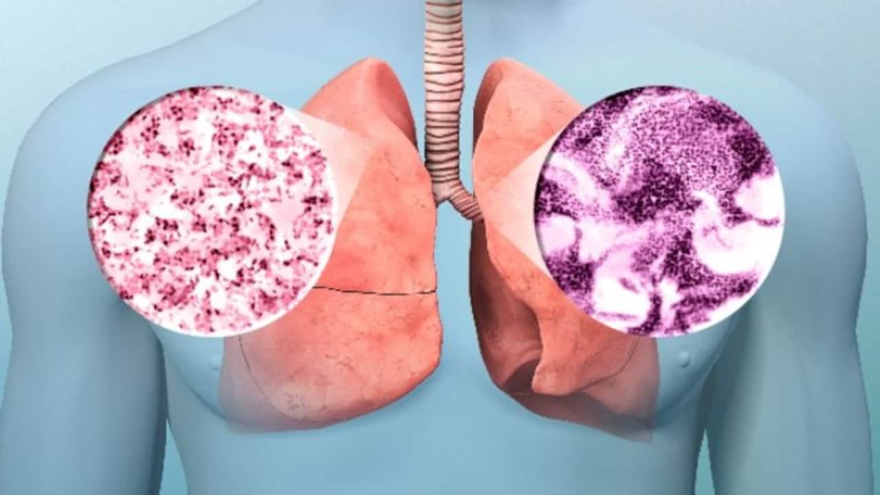 Lung cancer: धीरे धीरे लाखों जिंदगी निगल रहा लंग कैंसर, कहीं आप भी तो नहीं कर रहे ये गलतियां 