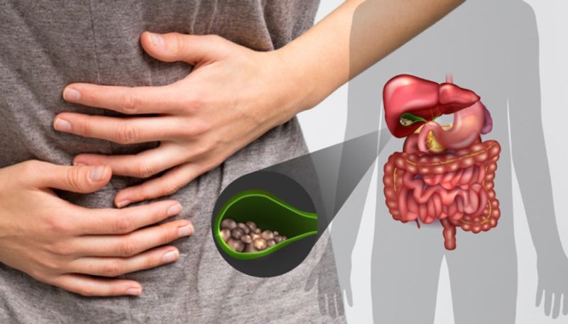 foods to prevent gall bladder stone 