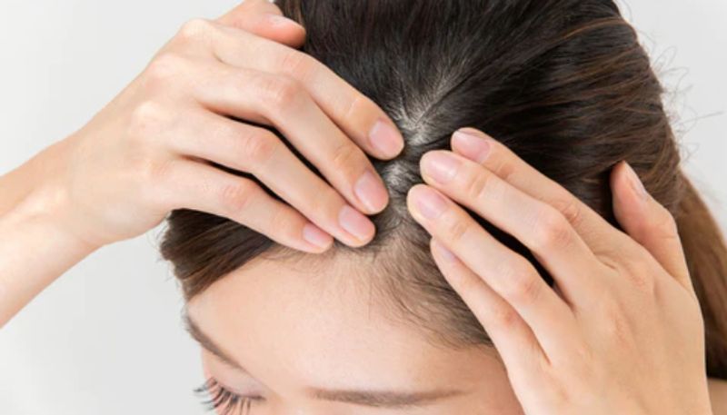 Signs and symptoms of Scalp Psoriasis