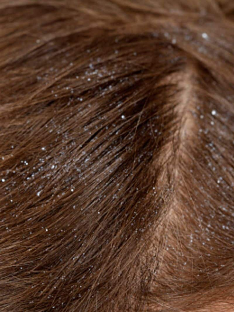 6 ways to reduce dandruff 