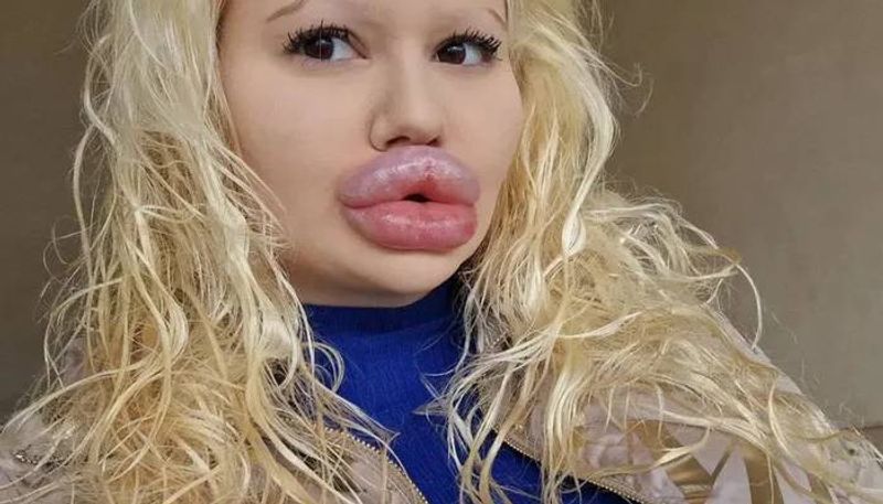 woman with worlds biggest lips undergoes six procedures in single day rlp