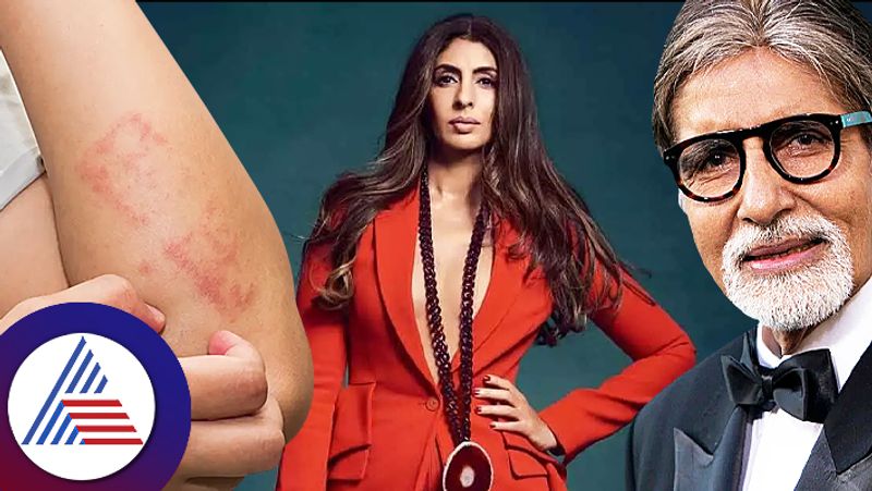 Amitabh Bachchans Daughter Shweta Bachcan Skin Disease Eczema Know Problems roo