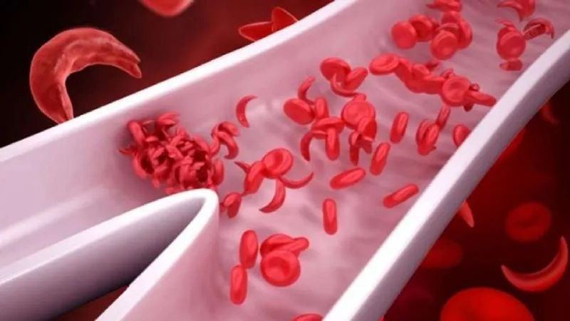 Understanding Sickle Cell Disease: Causes, symptoms, and diagnosis RBA