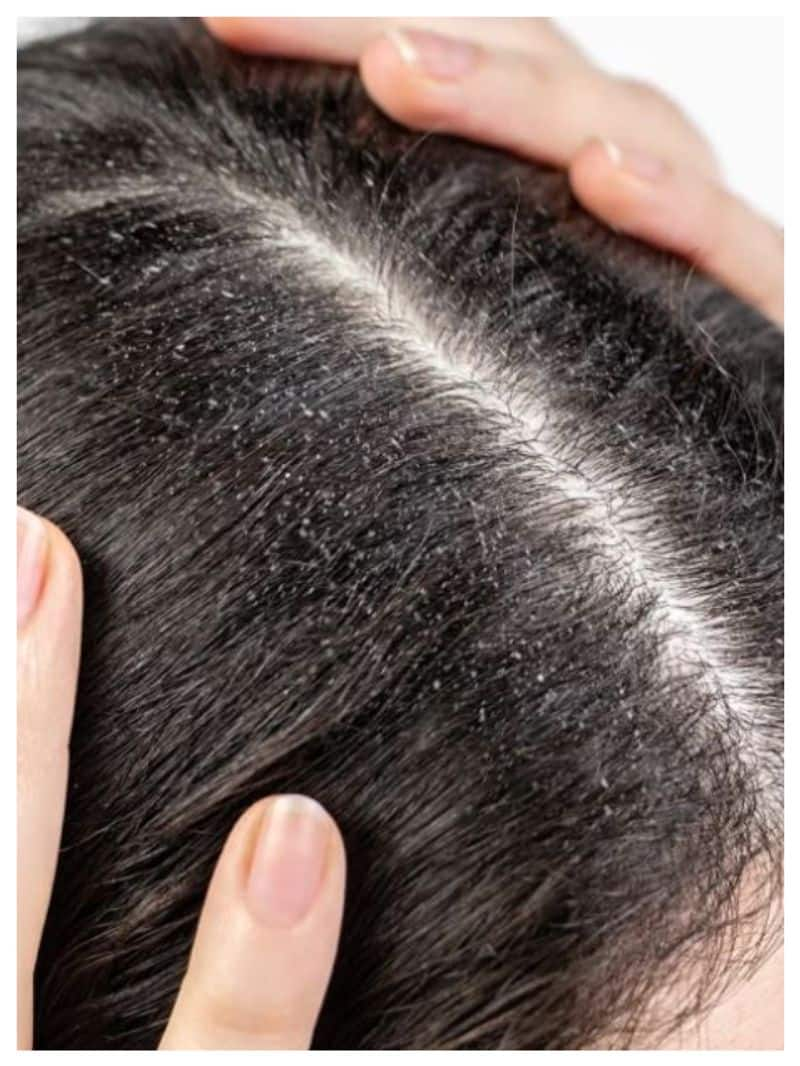 tips for prevent dandruff easily 