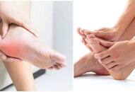 plantar fasciitis is main cause of Plantar fasciitis know how to relief from doctor irfan ahmed  xbw