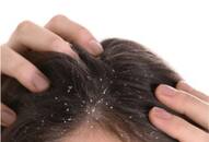 7 Homemade Remedies for Dandruff free scalp nti