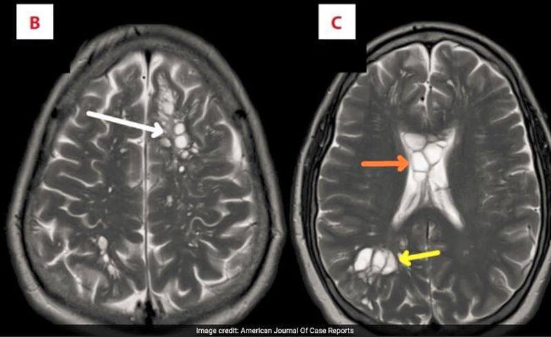 US Doctor Shocked after they saw tape worm in mans brain in US akb