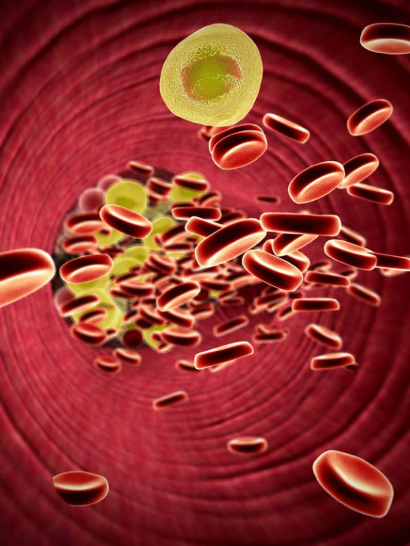 What are best ways to prevent high cholesterol? rsl