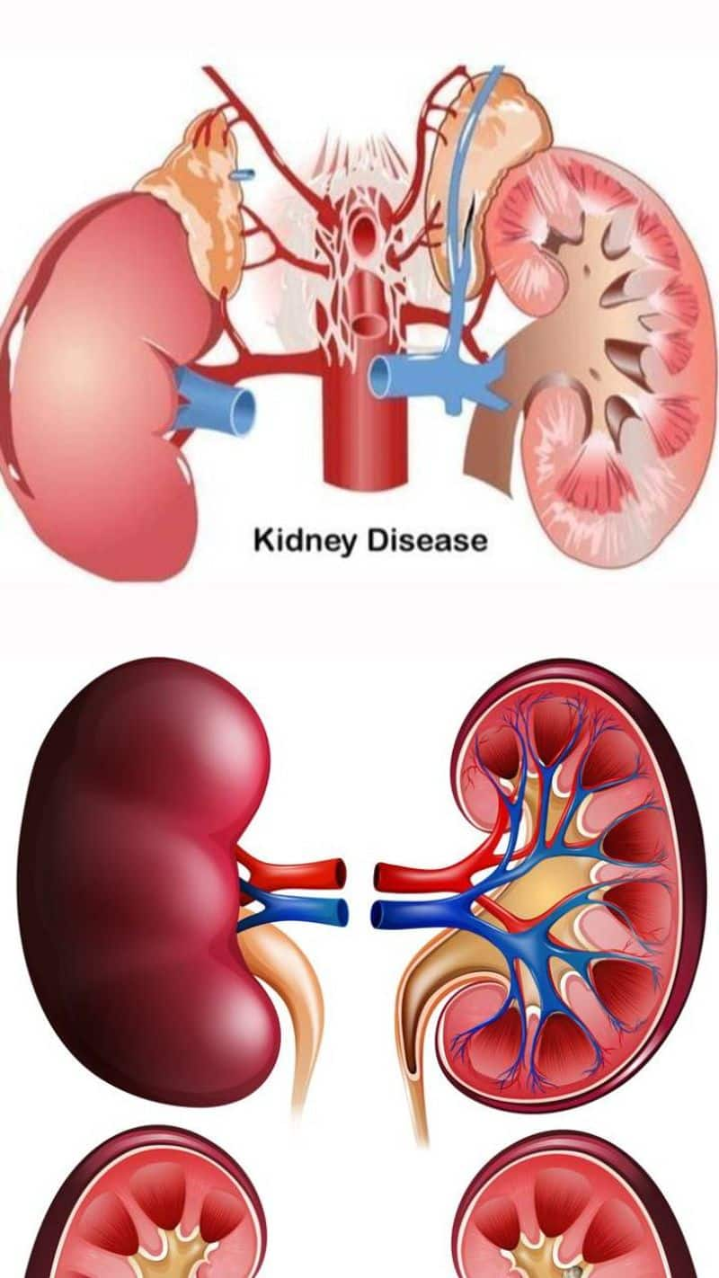 5 main reasons for kidney failure World Kidney Day 2024 xbw